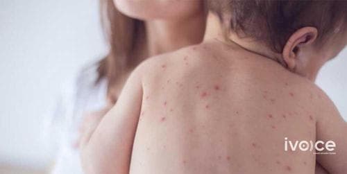 Бага насны хүүхдүүдийн дунд энтеровирусийн халдвар нэмэгджээ